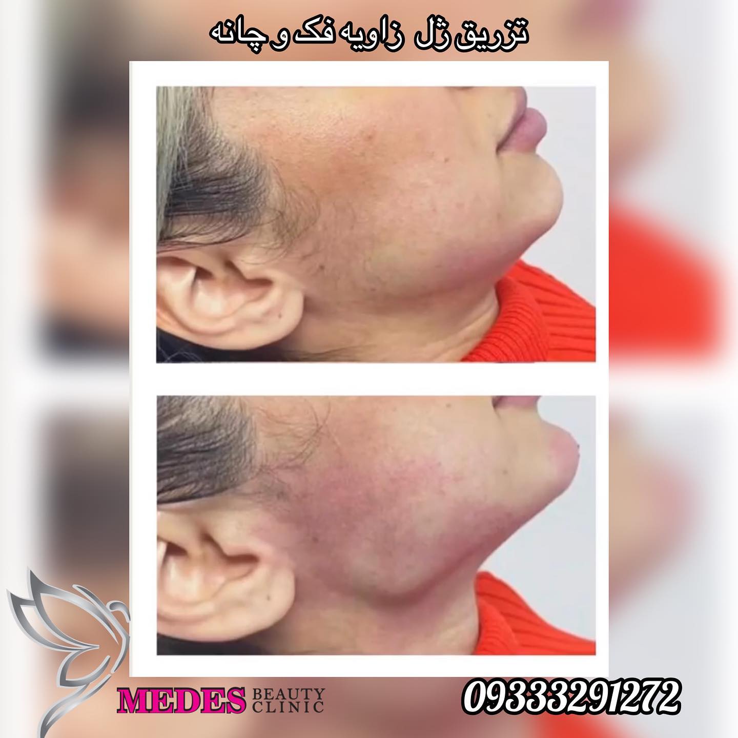 گالری زاویه سازی صورت